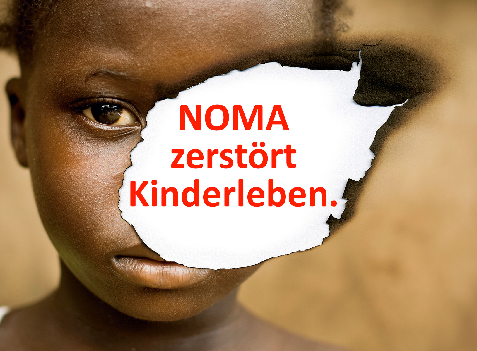 NOMA zerstört Kinderleben. Jährlich erkranken gemäss der Weltgesundheitsorganisati on WHO weltweit immer noch gegen 100‘000 Kinder an Noma. Wir schauen nicht weg!
