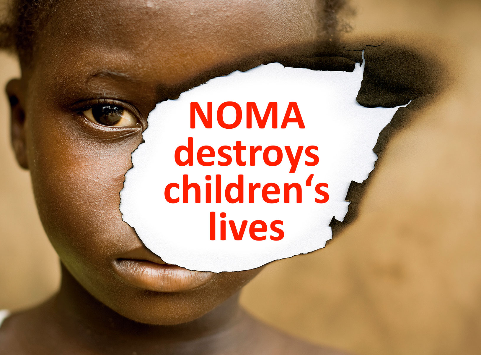 NOMA destroys children's lives